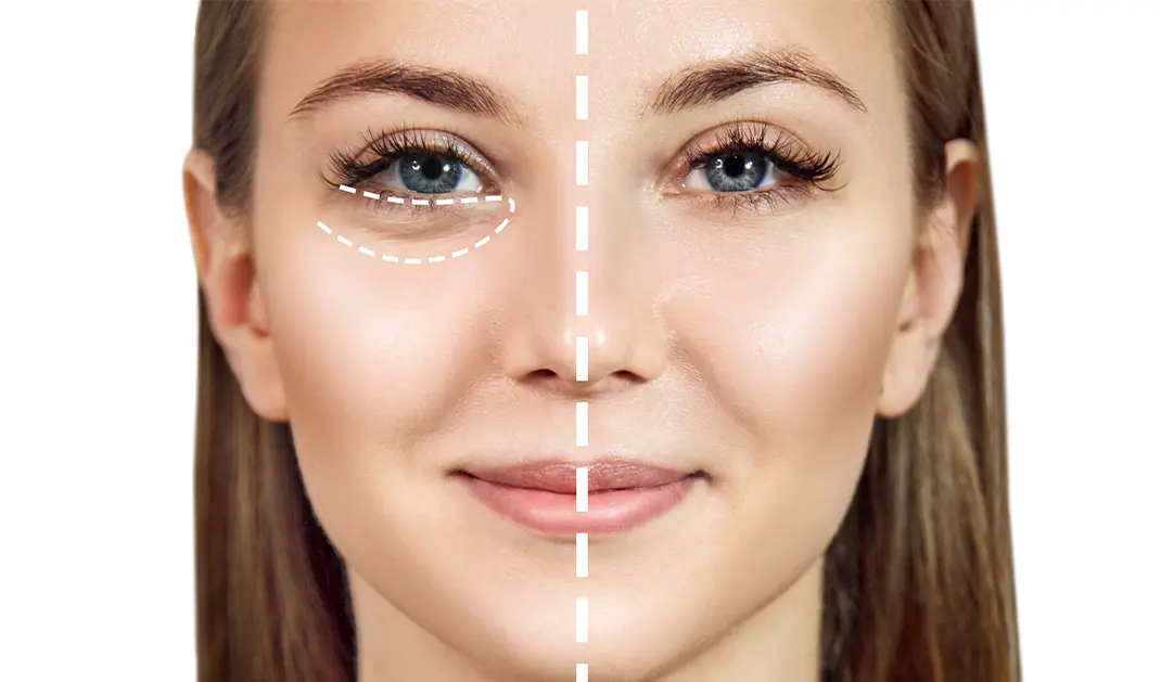 ALT GÖZ KAPAĞI AMELİYATI